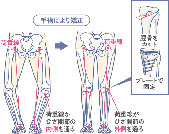 膝周囲骨切り術