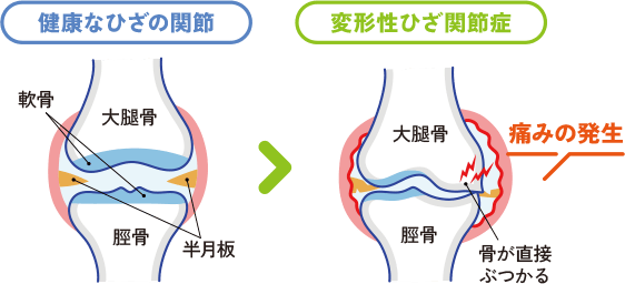 変形性ひざ関節症とは